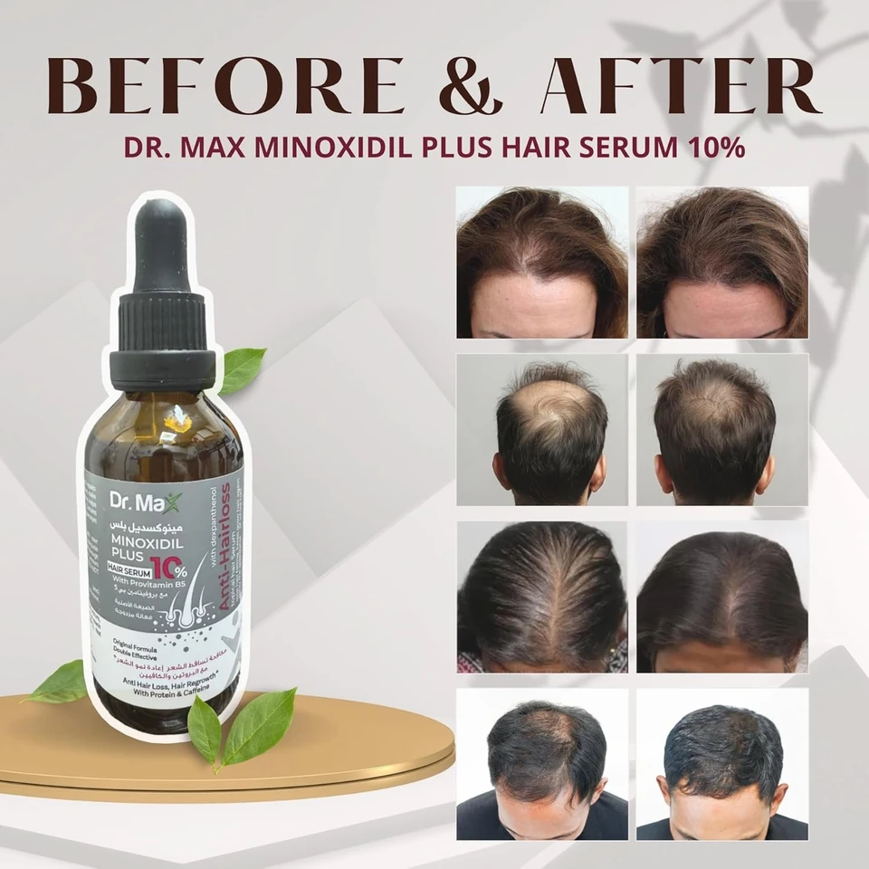 Dr Max Minoxidil Plus 10% Hair Serum With Provitamin B5 (Dexpanthenol) Anti Hair Loss, Hair Regrowth With Protein & Caffeine